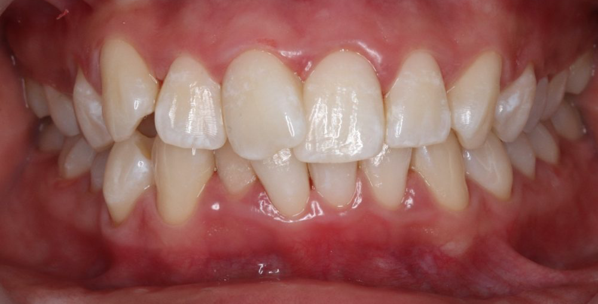 Résultat du traitement Invisalign avant et après
